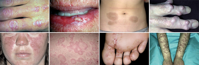 자가면역질환의 종류